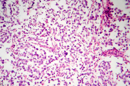 Testicular seminoma, light micrograph, photo under microscope. A most common germ cell tumor of the testisの写真素材