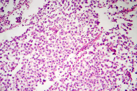Testicular seminoma, light micrograph, photo under microscope. A most common germ cell tumor of the...