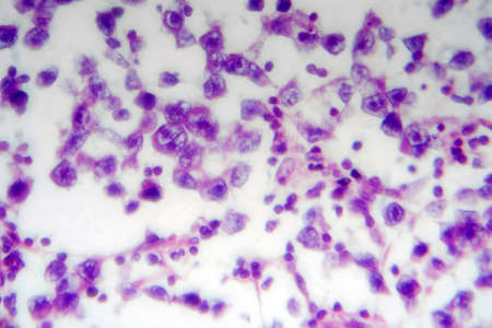Testicular seminoma, light micrograph, photo under microscope. A most common germ cell tumor of the testisの写真素材