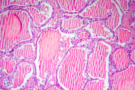 Follicular adenoma of thyroid gland, light micrograph. Histopathology of thydoid adenoma. Photo...