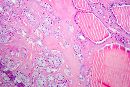 Follicular adenoma of thyroid gland, light micrograph. Histopathology of thydoid adenoma. Photo...