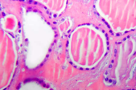 Follicular adenoma of thyroid gland, light micrograph. Histopathology of thydoid adenoma. Photo under microscopeの写真素材