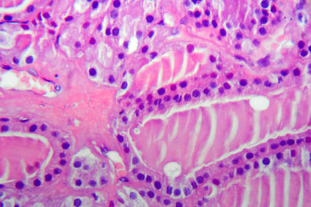 Follicular adenoma of thyroid gland, light micrograph. Histopathology of thydoid adenoma. Photo...