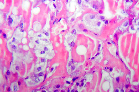 Follicular adenoma of thyroid gland, light micrograph. Histopathology of thydoid adenoma. Photo...