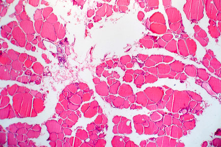 Thyroid cancer, light micrograph, photo under microscope