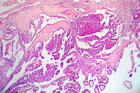 Papillary thyroid carcinoma, light micrograph, photo under microscope. The most common type of...
