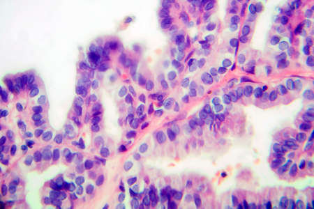Papillary thyroid carcinoma, light micrograph, photo under microscope. The most common type of thyroid cancerの写真素材