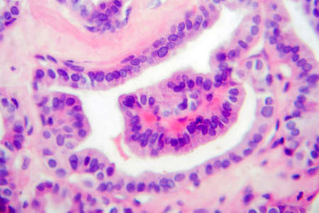 Papillary thyroid carcinoma, light micrograph, photo under microscope. The most common type of thyroid cancerの写真素材