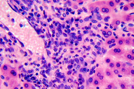 Coccidiosis, coccidia in liver, light micrograph, photo under microscopeの写真素材