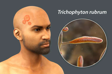 Fungal infection on a man's head and face, 3D illustration of a man with Tinea capitis and Tinea...
