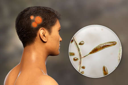 Fungal infection on a man's head, 3D illustration of a man with Tinea capitis and close-up view of...