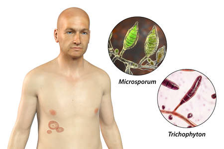 Fungal infection on a man's body. Tinea corporis and close-up view of dermatophyte fungi, 3D...