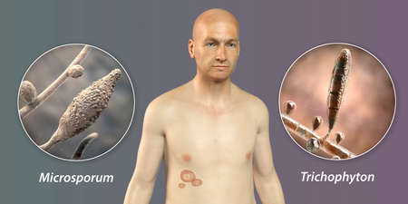 Fungal infection on a man's body. Tinea corporis and close-up view of dermatophyte fungi, 3D...