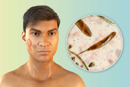 Fungal infection on a man's face, 3D illustration of a man with Tinea faciei and close-up view of...