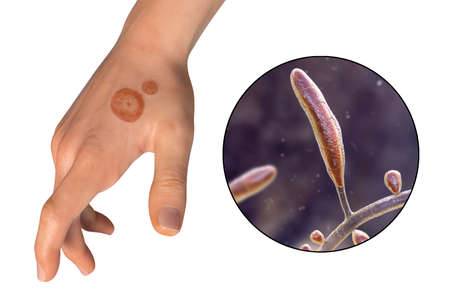 Fungal infection on a man's hand. Tinea manuum and close-up view of dermatophyte fungi Trichophyton...