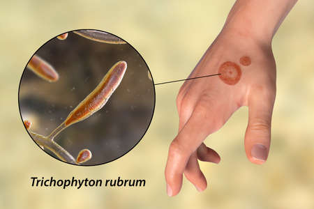 Fungal infection on a man's hand. Tinea manuum and close-up view of dermatophyte fungi Trichophyton...