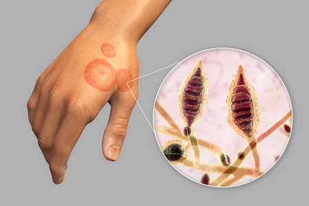 Fungal infection on a man's hand. Tinea manuum and close-up view of dermatophyte fungi Microsporum...