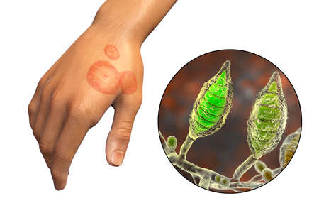 Fungal infection on a man's hand. Tinea manuum and close-up view of dermatophyte fungi Microsporum...
