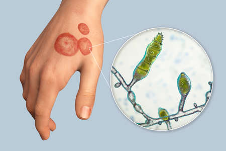 Fungal infection on a human hand. Tinea manuum and close-up view of dermatophyte fungi Microsporum...