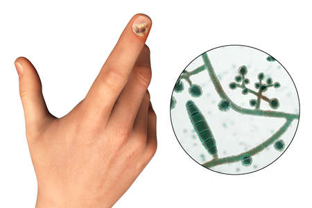 Human hand with onychomycosis and close-up view of Trichopyton mentagrophytes fungi, one of the...