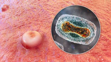 Skin lesions in monkeypox infection and close-up view of monkeypox virus, 3D illustration. A...