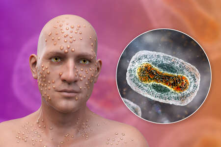 A man with skin boils caused by pox viruses and close-up view of the virus, 3D illustration. Smallpox, monkeypox and other pox virus infectionsの写真素材