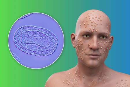 A man with skin boils caused by pox viruses and close-up view of the virus, 3D illustration. Smallpox, monkeypox and other pox virus infectionsの写真素材