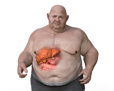 Fibrotic liver in obese man, 3D illustration. Concept of obesity and inner organs diseases, behavioral problem, binge eating disorder, food addiction. Liver steatosis and steatohepatitisの写真素材