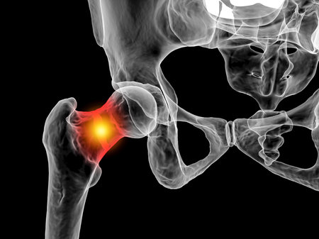 A fracture of the femur neck, a common type of hip fracture that typically occurs in older adults and can lead to mobility issues and other complications, isolated on white background, 3D illustrationの写真素材