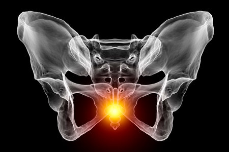 A 3D medical illustration highlighting the coccyx bone marked in red, depicting coccyx pain which can occur due to injury, childbirth, or prolonged sitting. Front viewの写真素材