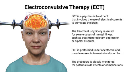 Electroconvulsive therapy, ECT, a treatment used for severe mental illnesses involving the use of electrical currents to stimulate the brain, 3D illustrationの写真素材