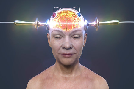 Electroconvulsive therapy, ECT, a treatment used for severe mental illnesses involving the use of...