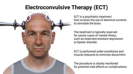 Electroconvulsive therapy, ECT, a treatment used for severe mental illnesses involving the use of electrical currents to stimulate the brain, 3D illustrationの写真素材
