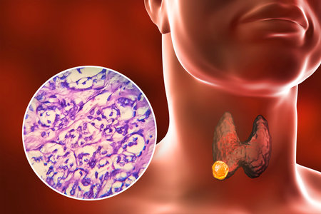 A 3D scientific illustration showcasing a human body with transparent skin, revealing a tumor in his...