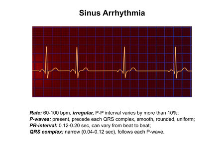 A detailed 3D illustration of an Electrocardiogram ECG displaying sinus arrhythmia, a condition characterized by irregular heart rhythms originating from the sinus node.の写真素材