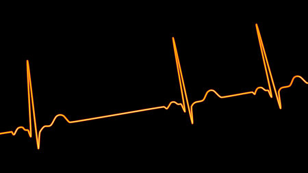 A detailed 3D illustration of an Electrocardiogram ECG displaying sinus arrhythmia, a condition...