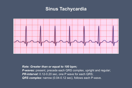 Electrocardiogram (ECG) displaying sinus tachycardia, a regular cardiac rhythm with heart rate that is higher than the upper limit of normal of 90-100 bpm in adults, 3D illustration.の写真素材