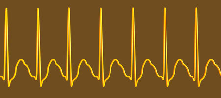 ECG in supraventricular tachycardia, a rapid heart rate originating above the ventricles, causing...