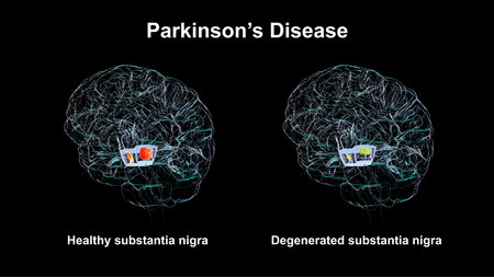 Subtantia nigra in healthy human brain (left) and degenerated substantia nigra in Parkinson disease (right), 3D illustrationの写真素材