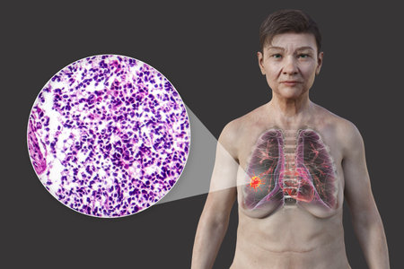 A woman with lung cancer, 3D illustration, along with a micrograph image of small cell lung cancer.の写真素材