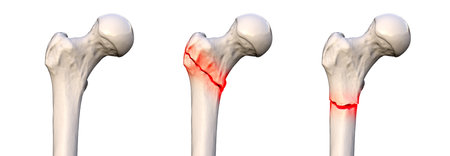 Femur fracture types: normal femur, intertrochanteric fracture, and subtrochanteric fracture, from left to right, 3D illustration.の写真素材