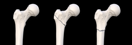 Femur fracture types: normal femur, intertrochanteric fracture, and subtrochanteric fracture, from left to right, 3D illustration.の写真素材