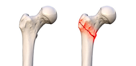 Intertrochanteric femur fracture (right) and normal femur (left), 3D illustration showing a break between the greater and lesser trochanters of the femur.の写真素材