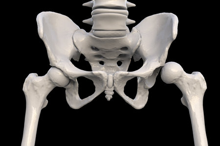 Hip dysplasia (dislocation type), 3D illustration showing misalignment of the femoral head and hip socket, highlighting skeletal anatomy and joint abnormality.の写真素材