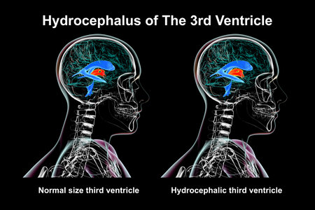 A 3D scientific illustration depicting isolated enlargement of the third brain ventricle (right) compared to the normal size third ventricle (left), side view.の写真素材