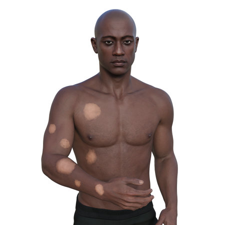 3D illustration of a dark-skinned man depicting tuberculoid leprosy with depigmented lesions on his arm and trunk.の写真素材
