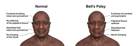 Facial palsy in a man, and the same healthy person, photorealistic 3D illustration highlighting the asymmetry and drooping of the facial muscles on one side of the face.の写真素材