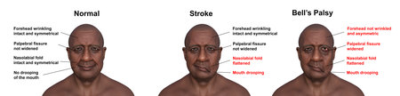 A man showing left-side stroke (center), facial palsy (right), and the same healthy person (left), 3D illustration.の写真素材