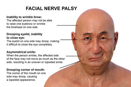 Facial palsy in a man, photorealistic 3D illustration highlighting the asymmetry and drooping of the facial muscles on one side of the face.の写真素材