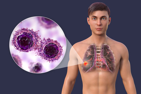 A 3D photorealistic illustration of a man with transparent skin, revealing the presence of lung cancer, and close-up view of cancer cells.の写真素材